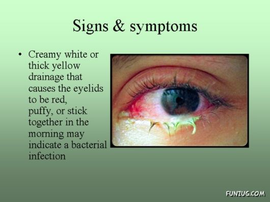Know Everything About Conjunctivitis