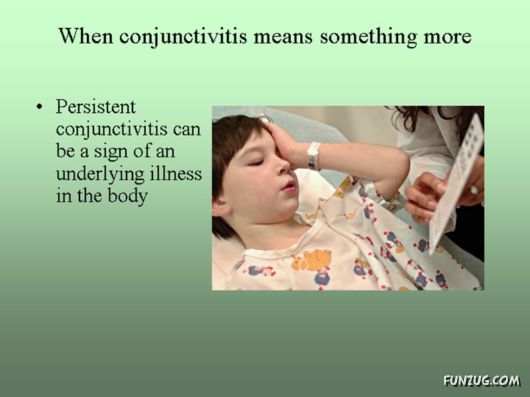 Know Everything About Conjunctivitis