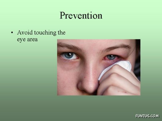 Know Everything About Conjunctivitis
